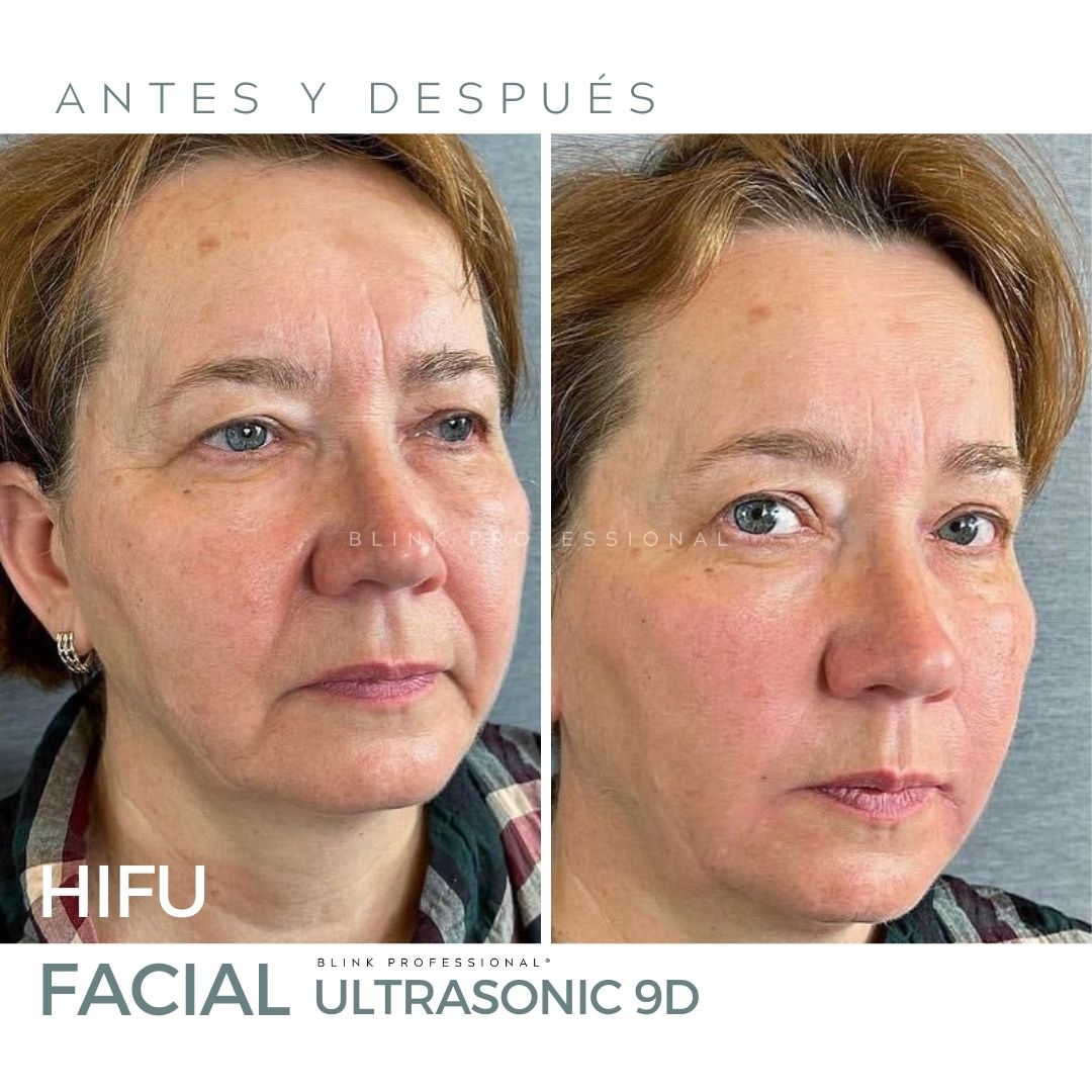Ultrasonic 9D (Nuevo)