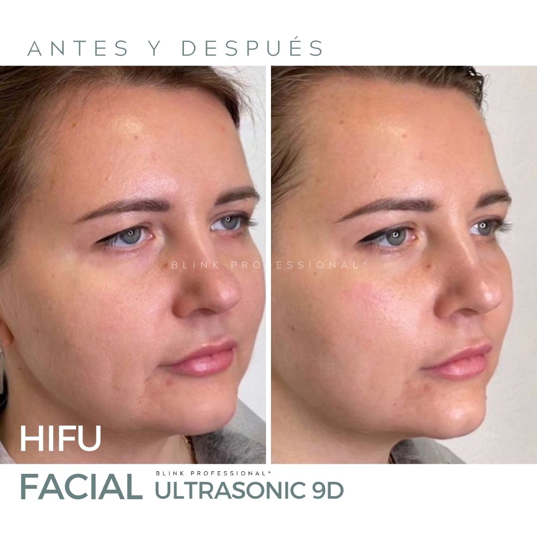 Ultrasonic 9D (Nuevo)