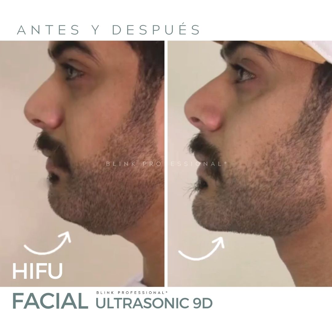Ultrasonic 9D (Nuevo)