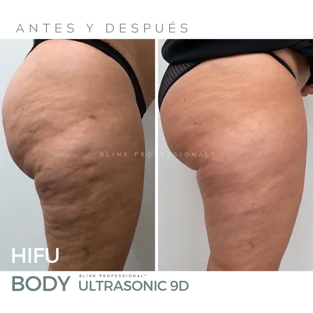 Ultrasonic 9D (Nuevo)