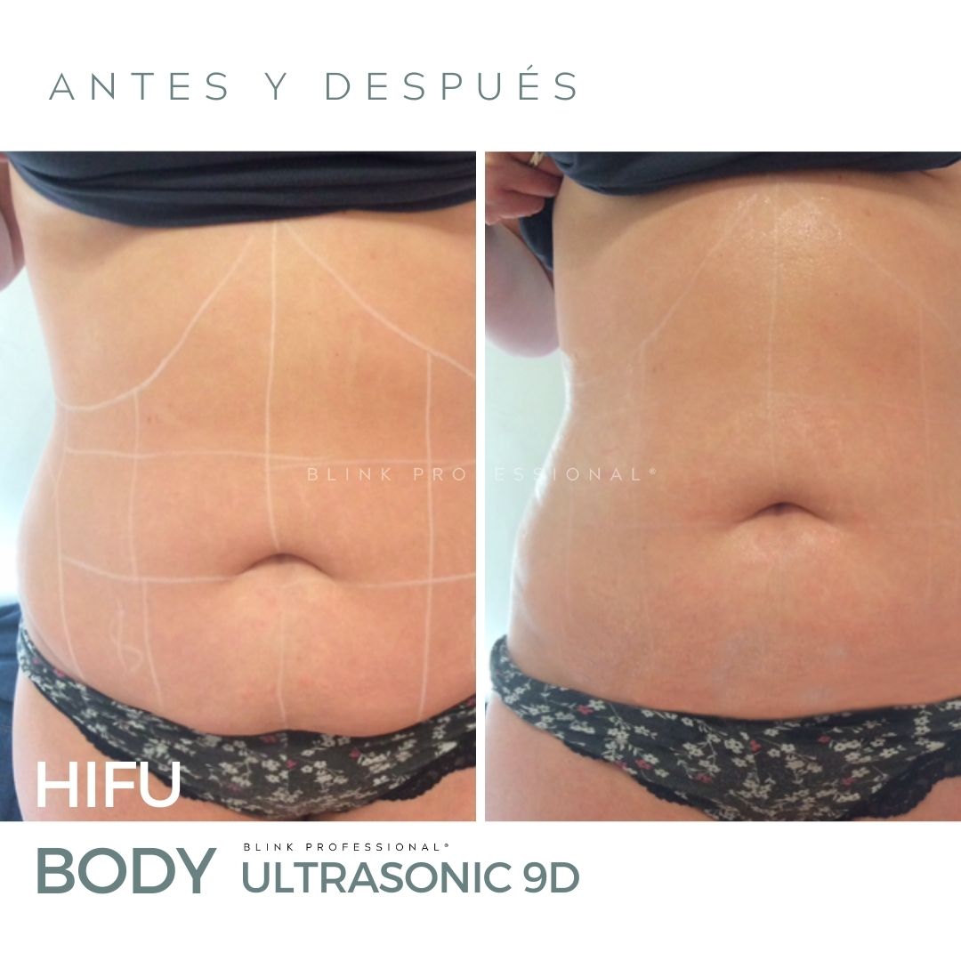 Ultrasonic 9D (Nuevo)
